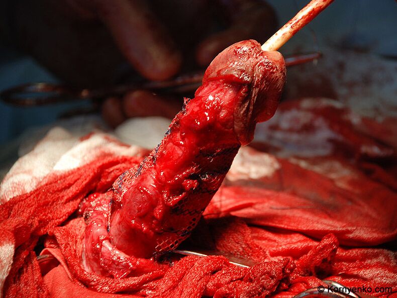 Installation einer Kollagenmatrix zur Penisvergrößerung