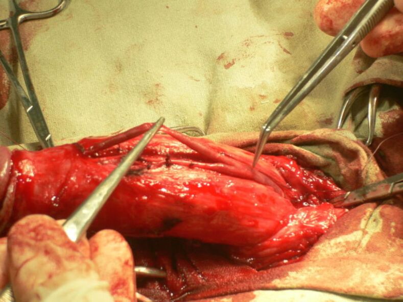 Lipofilling des Penis zur Vergrößerung