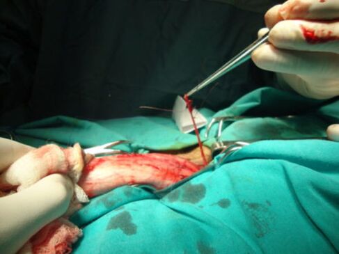 Penisvergrößerungsoperation