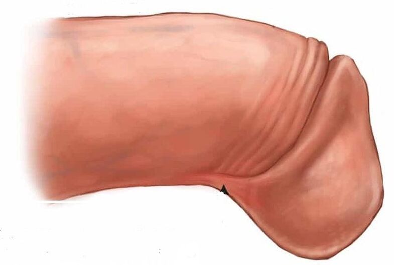 wie man die Eichel vergrößert